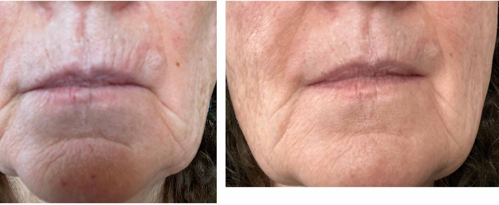 Bakuchiol before and after photos - bareLUXE Skincare
