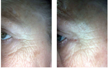 bakuchiol before and after - user submitted photo
