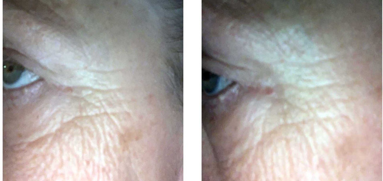 bakuchiol serum before and after photos