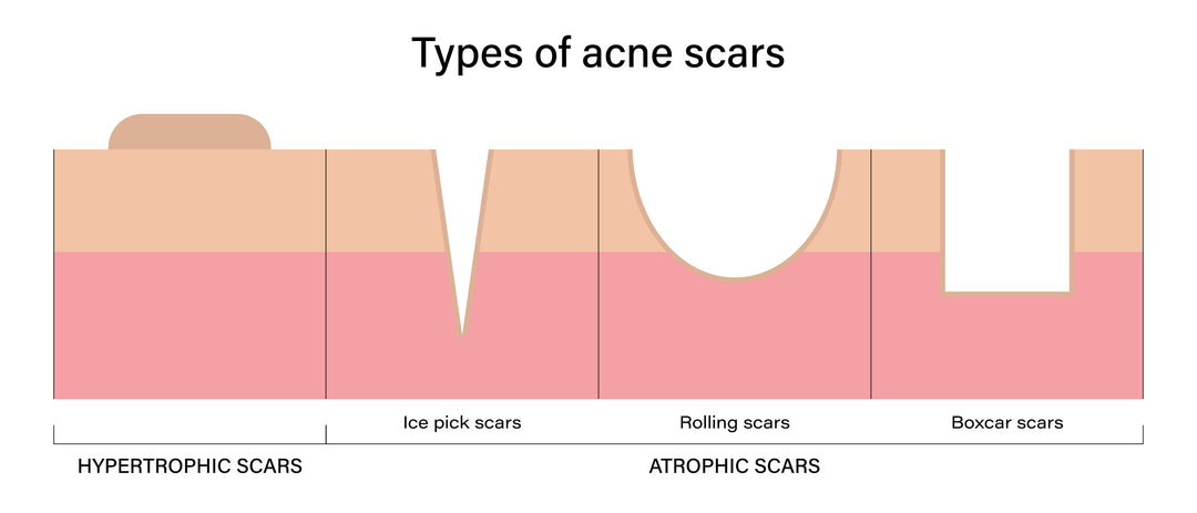 Stock photo of the types of acne scars