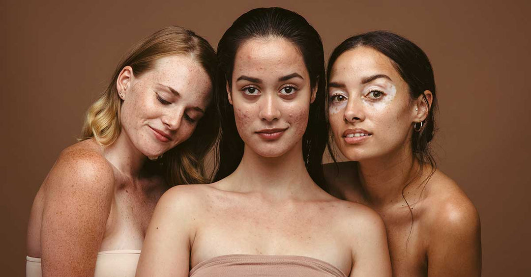 photo of 3 women with skin conditions like acne looking strong and beautiful