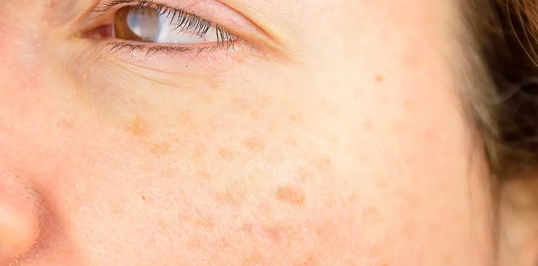 stock photo of hyperpigmentation spots on face