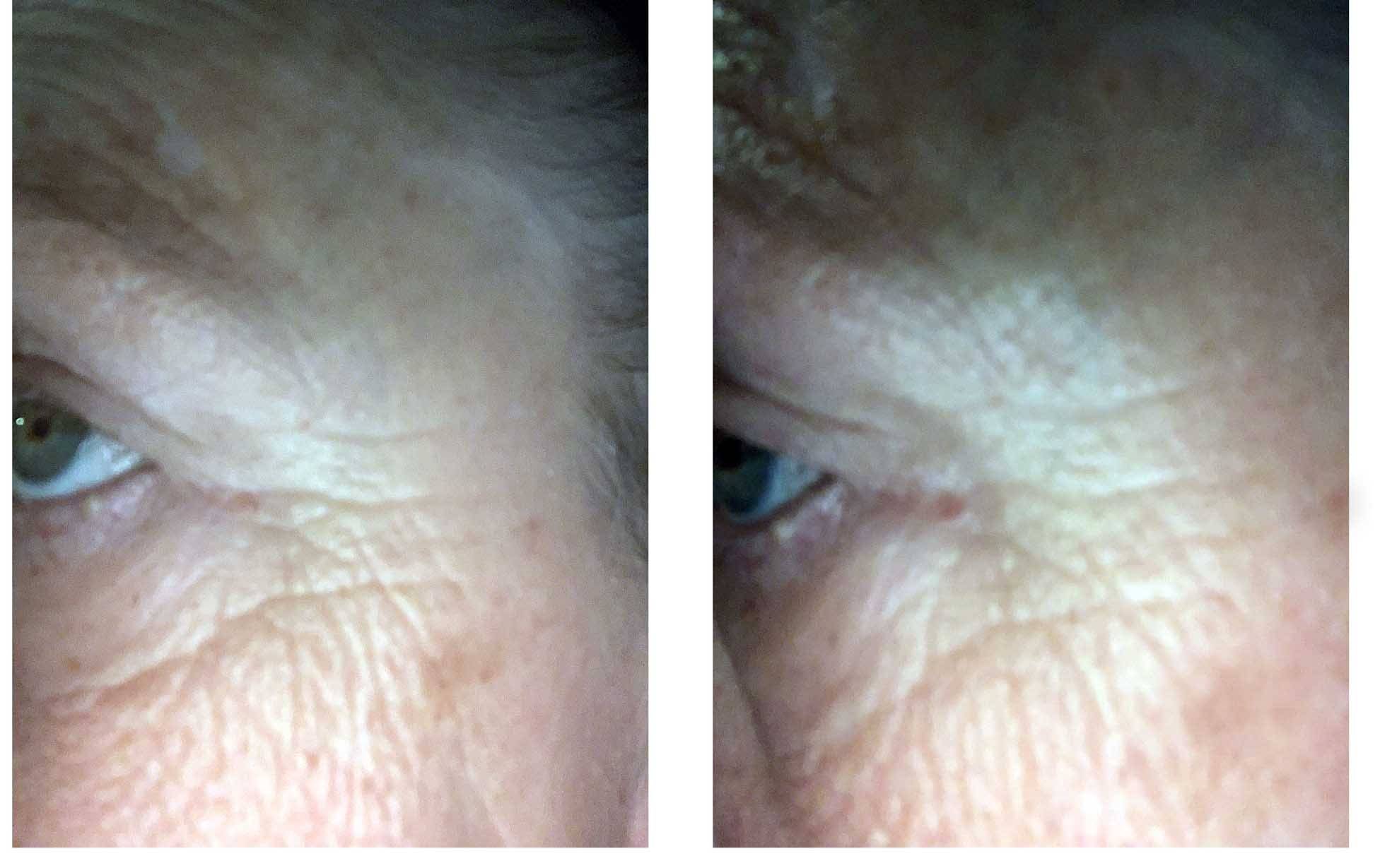 bakuchiol before and after - user submitted photo